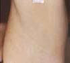 ipl_rf_e_light_silver