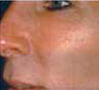 ipl_rf_e_light_silver