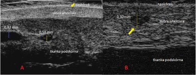 Fot. 3 Ocena drobnych naczyń krwionośnych za pomocą ultrasonografu wysokich częstotliwości. A – naczynia położone w tkance podskórnej (aparat Derma View Dramiński z głowicą 48 MHz, B – teleangiektazje w skórze właściwej (aparat Episcan z głowicą 50 MHz