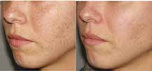Fot. 3. Efekt terapii laserowej - usuwanie znamion na policzkach i nosie