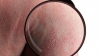 Dermokosmetyczna pielęgnacja skóry z AZS i łuszczycą